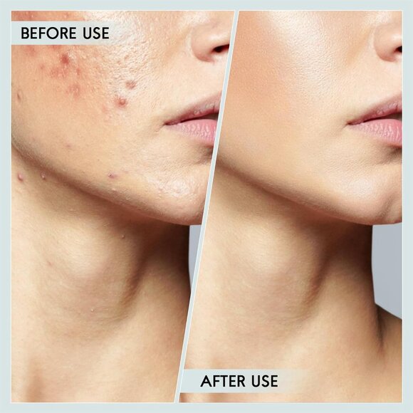 USB Pore Blackhead Remover Vacuum + Steel Blackhead Remover Pimple Popper Tool - Picture 14 of 15